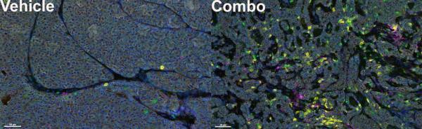 After combination therapy, many more tumor-fighting immune cells enter the tumor. Immune cells in the tumor: T cells (green), CD8+ T cells (yellow).
